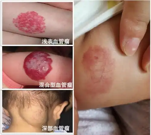 血管瘤会自行消退婴儿血管瘤治是不治