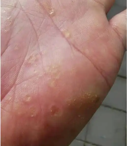 深圳问止中医门诊部:李宇晴调理角化性湿疹