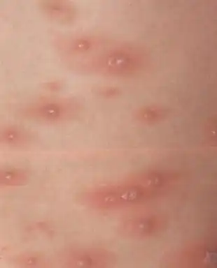 小儿推拿及三豆饮治疗水痘(伴发热)有良效