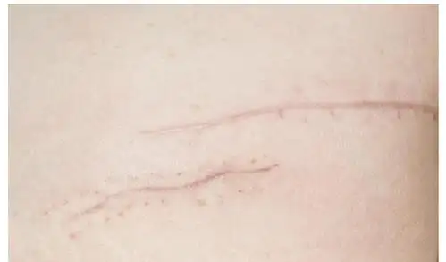 十个顺产九个切, 为什么医院都默认侧切? 医生告诉你事实