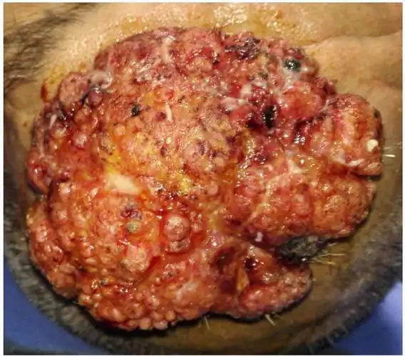 1,良性肿瘤的瘤细胞在形态和功能上接近于相应组织的正常细胞.