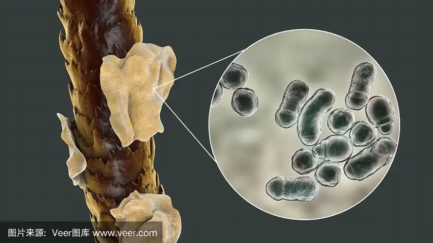 有头皮屑的人类头发和显微镜下的真菌糠秕马拉色菌的近景