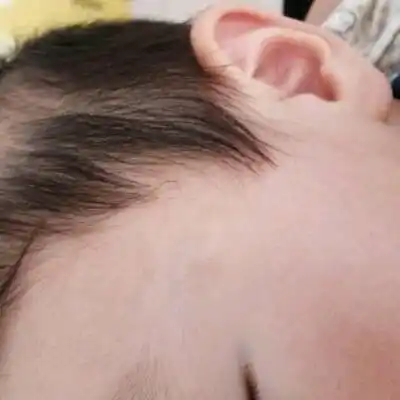 宝宝脸上的色素沉着能消退吗?