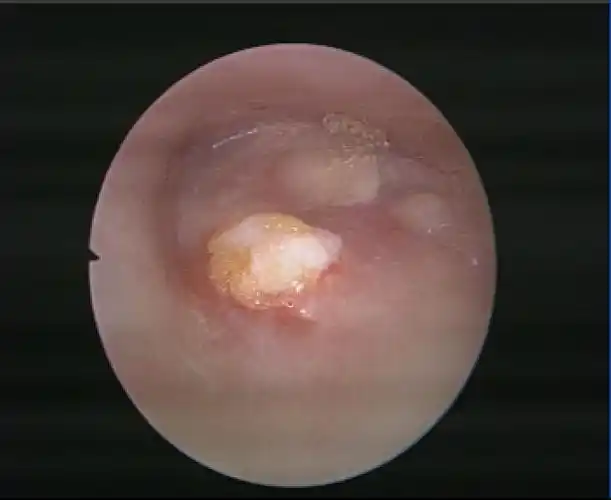 中耳炎鼓膜穿孔图片