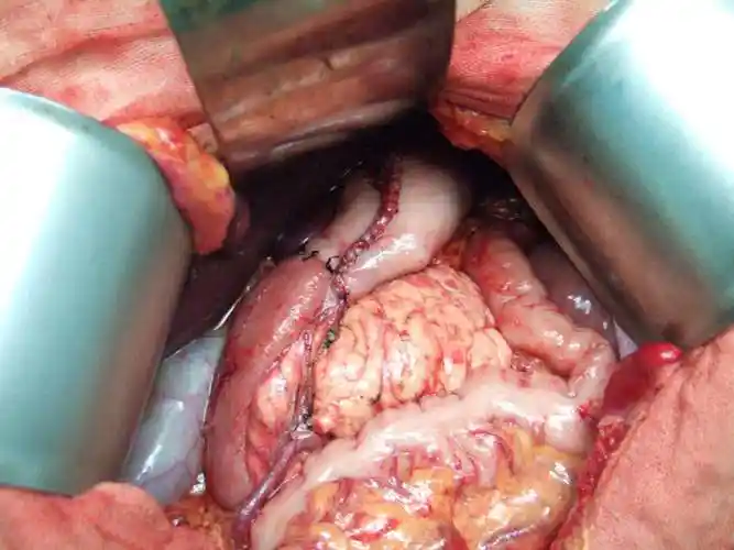 胃癌标准d2根治术-毕i式重建 - 好大夫在线