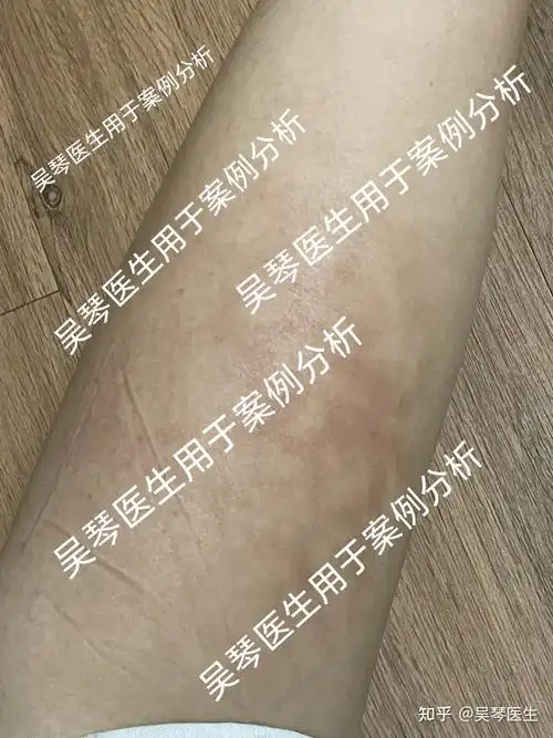 火激红斑小太阳烤出来的网状斑