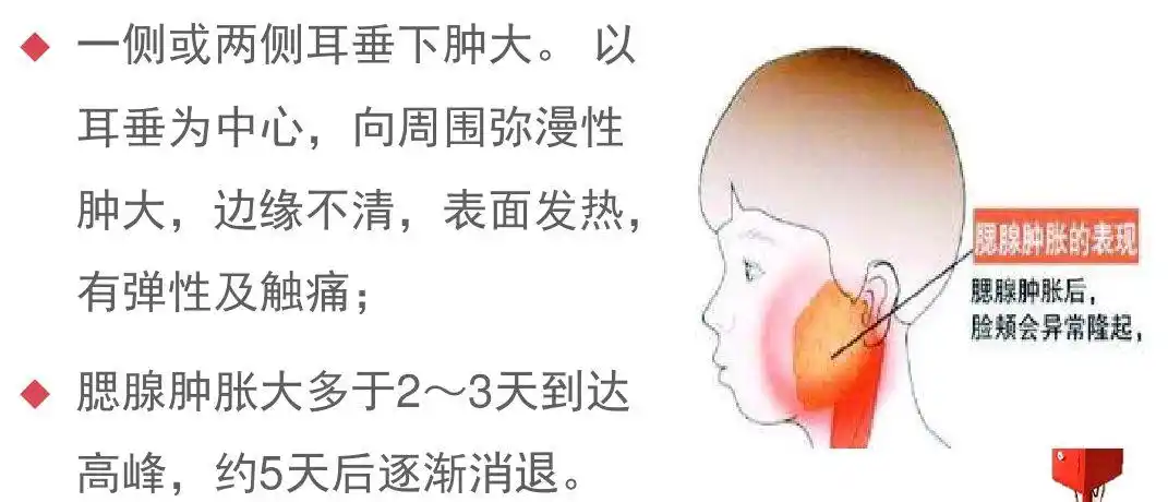 流行性腮腺炎的症状         出现腮腺炎症状后,患者要尽快隔离,到