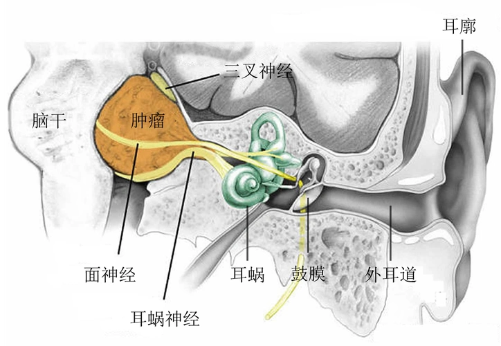 耳科医生在听神经瘤早期诊断和治疗中的优势_听神经瘤_症状表现_治疗