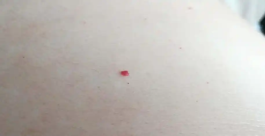 朱砂痣长在哪里优质