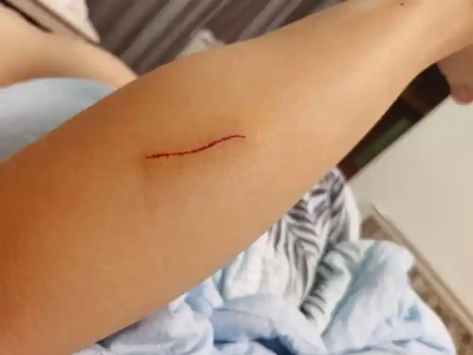 受伤的大腿肚子