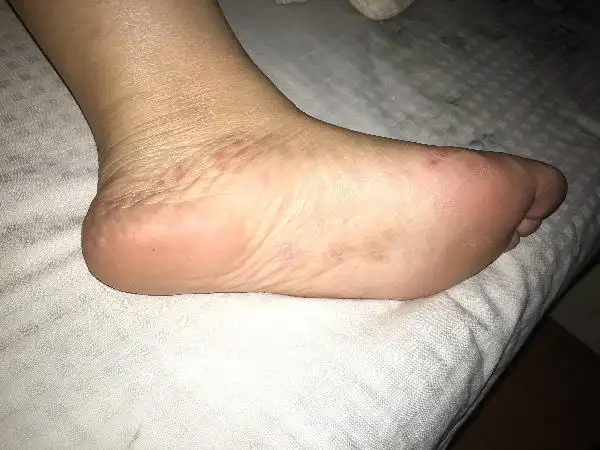 脚上起红点,已经有一段时间了,没消反而起得越来越多,现在还很痒!