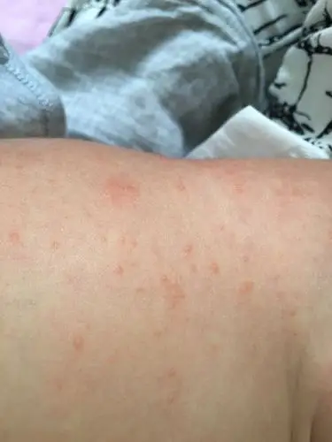 刚才给宝宝换尿不湿的时候突然发现他大腿根和背部长了这些红痘痘是什