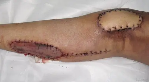 胫前皮肤缺损术后供区植皮