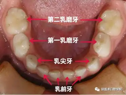 替牙期,六龄齿最早萌出恒牙列(12岁左右~一生):上下颌共28~32颗牙齿