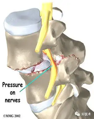 4)骨结构的改变:椎体前后缘反应性唇样骨增生,椎体楔形变等.