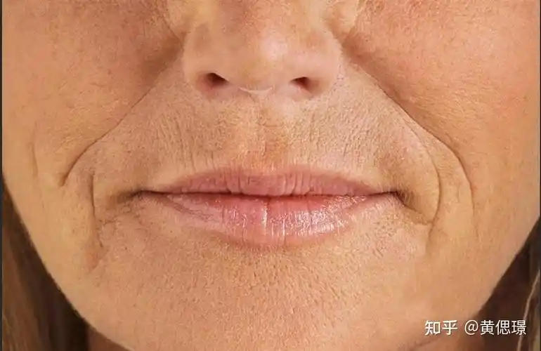 一:什么是法令纹?