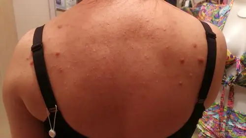 后背粉刺多年怎么治疗? - 皮肤与性传播疾病讨论版 -丁香园论坛