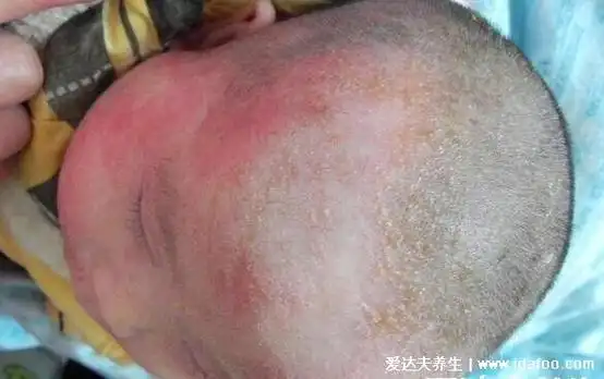 婴儿奶癣是什么样子的图片,就是湿疹有3种类型注意区分(附护理法)
