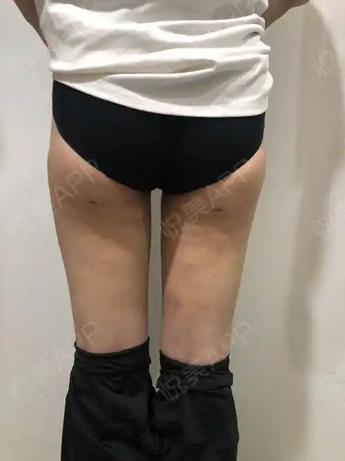 之前就是大腿外侧肉有点多,然后也不算太胖,就是整体.瘦全身_悦美整形