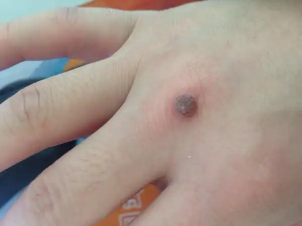 手上长个东西,应该是公瘊子,就一个,挺长时间了,该用什么药去掉?