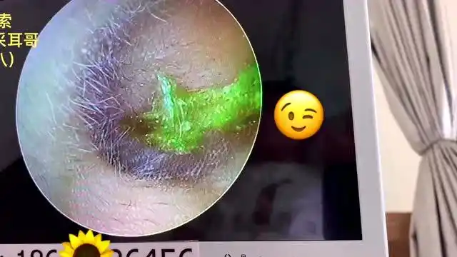 耳屎掉到鼓膜上面,晃头有咚咚声