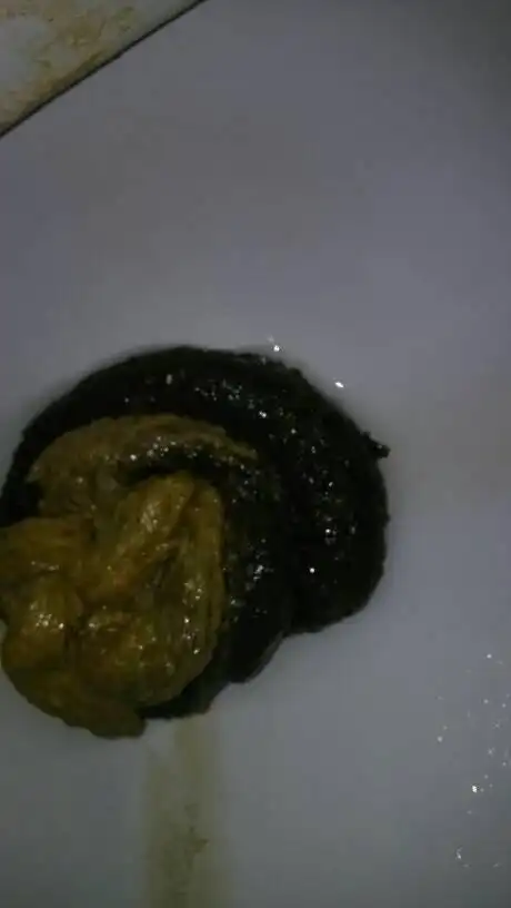 我以前都不这样.吃了胃药开始就是这样了.是不是消化道出血啊?