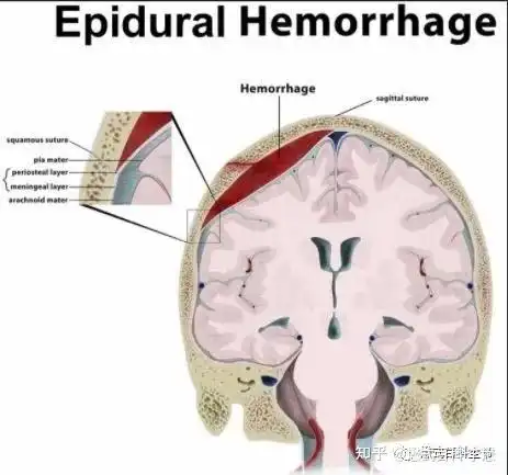 颅内血肿的影像诊断及鉴别诊断