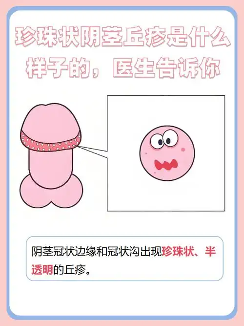 珍珠状阴茎丘疹是什么样子的,医生告诉你