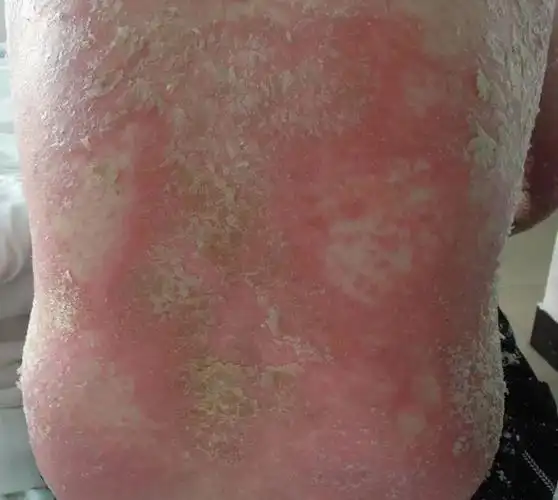 红皮型银屑病的症状表现与危害介绍,含护理方法 - 伊顿健康