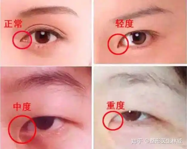 块垂直的皮肤遮盖了我们的内眼角,内眦赘皮的存在会使人的眼睛比较小