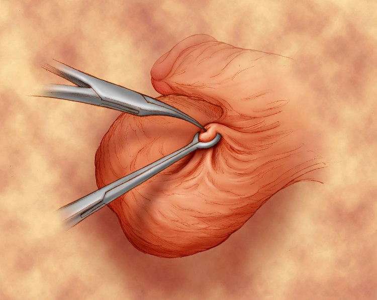 当然,男人若做过输精管结扎手术,而现在的条件和政策都允许再要孩子