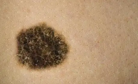 皮肤癌早期症状图片大全