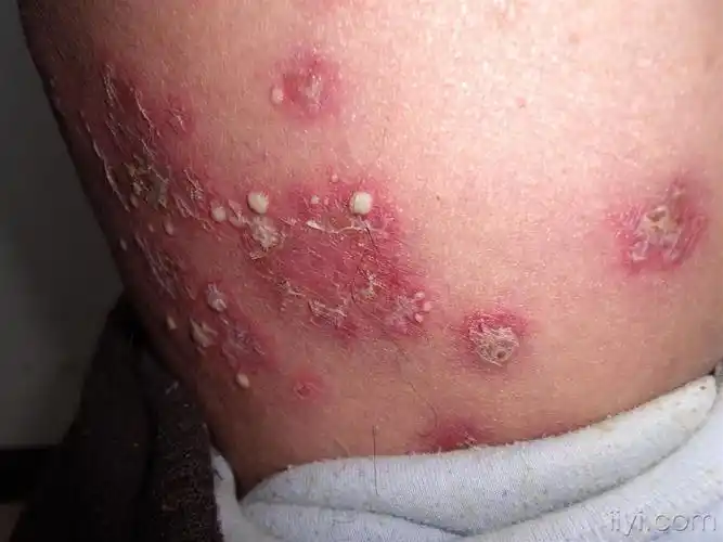 角层下脓疱性皮病门诊照片