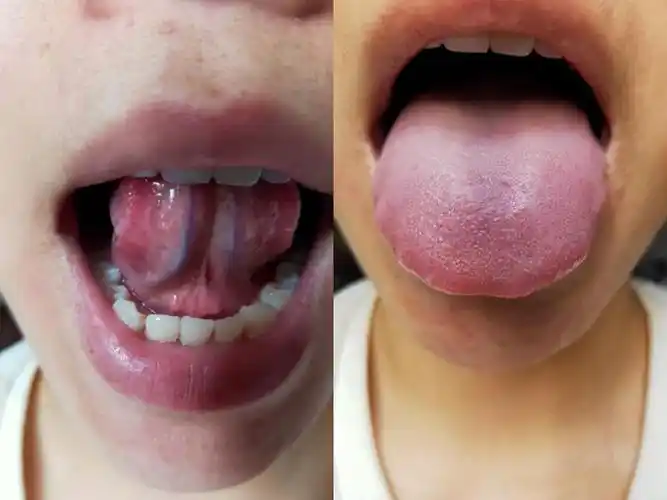 舌诊案例肝郁湿气重血瘀的舌象分别什么样