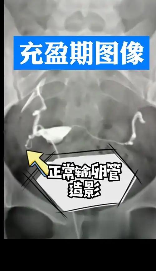 输卵管堵塞输卵管造影大全不会看的姐妹们来对照看看你是属于哪一种
