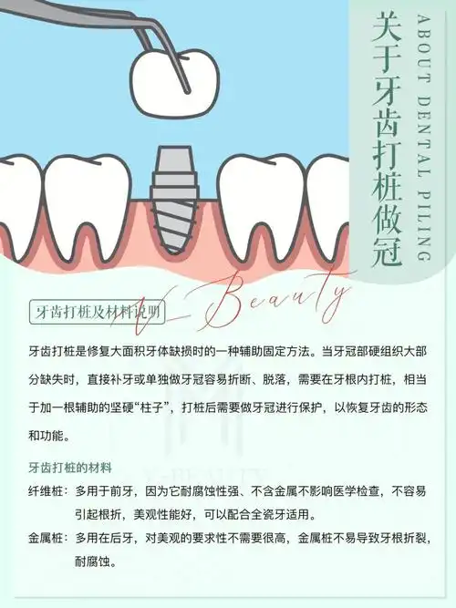 一天一个口腔小知识关于牙齿打桩做冠