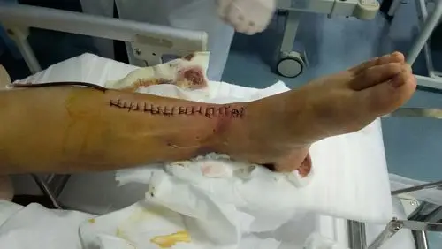 2018年间林勇11月10日脚摔断住院到做完手术11月20期间图片,12月6日