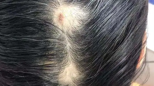 头皮温度升高,油脂分泌异常,大量的油脂会堵塞毛囊让头发变得越来越细