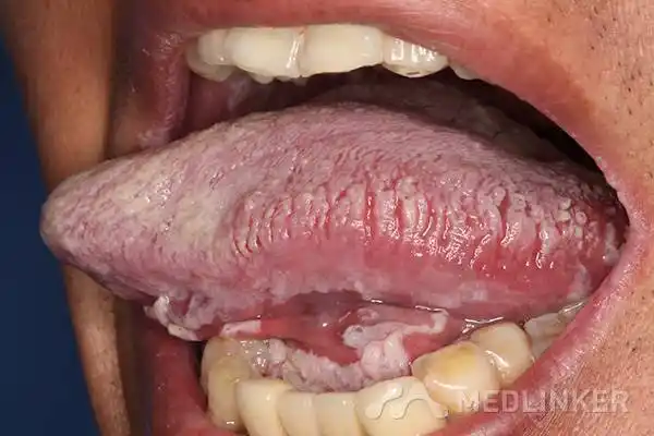 hiv感染相关的口腔念珠菌病2例