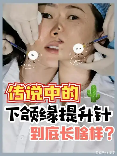 传说中的下颌缘提升针,到底长啥样?