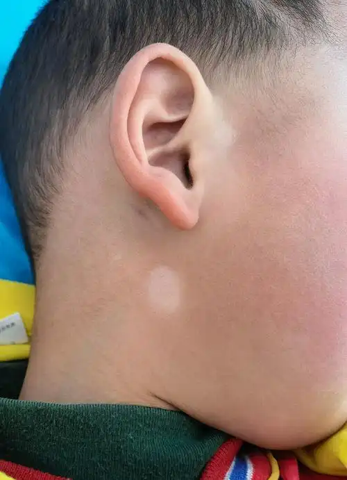 儿童白色糠疹的症状特点为好发于面部,亦多见于颈肩上臂处,色素减退性