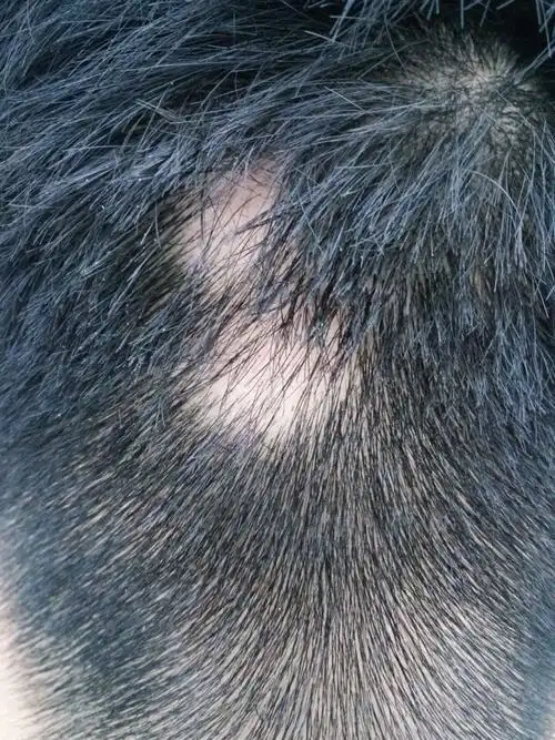 我的后脑勺有一处硬币大小没有头发 是什么原因?我才20岁