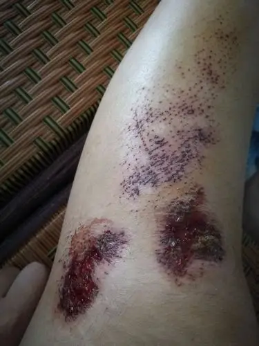 擦伤,挺严重的,伤口现状如下,还有七天就得高中军训了,能好好军训吗