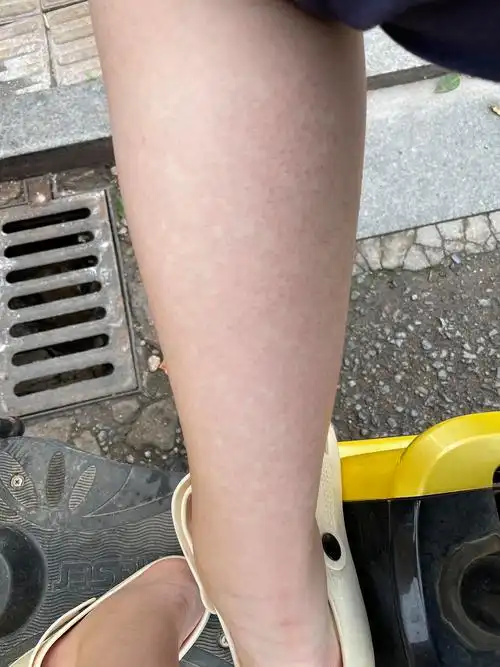 我的小腿上这种不规则的白斑是什么啊