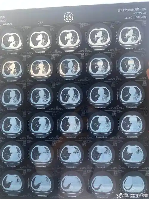 什么肺炎的ct影像如此与众不同