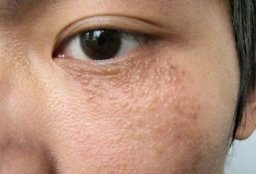 汗管瘤图片眼部图片 (4)