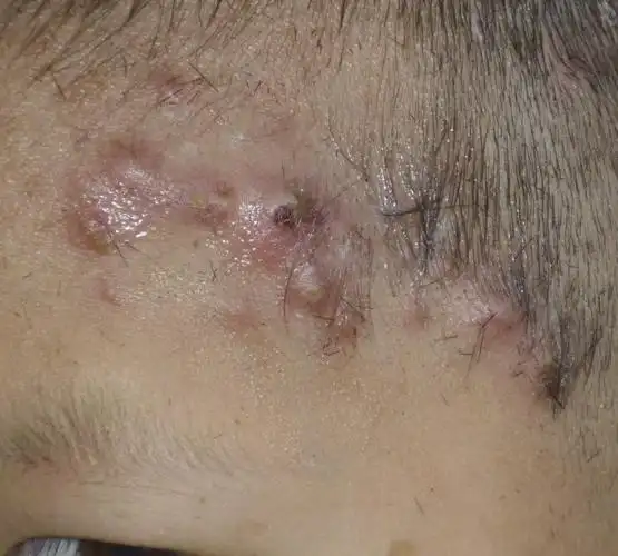 其次为白色葡萄球菌)侵入毛囊及周围组织引起的急性化脓性炎症