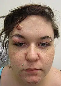 结节痤疮的人脸照片