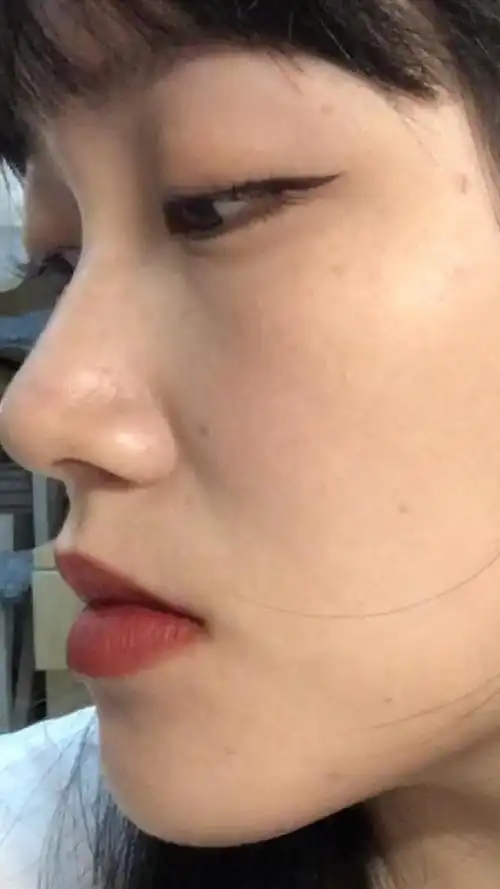 求助我这算鼻基底凹陷吗