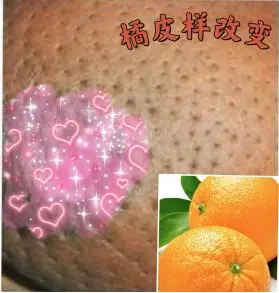 观察两侧乳房是否对称,乳房皮肤有无红肿,破溃,凹陷(橘皮样改变).